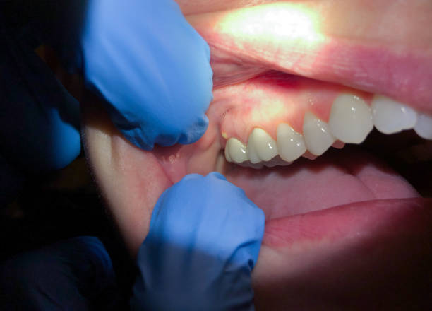 Best Emergency Tooth Extraction in Madison, GA